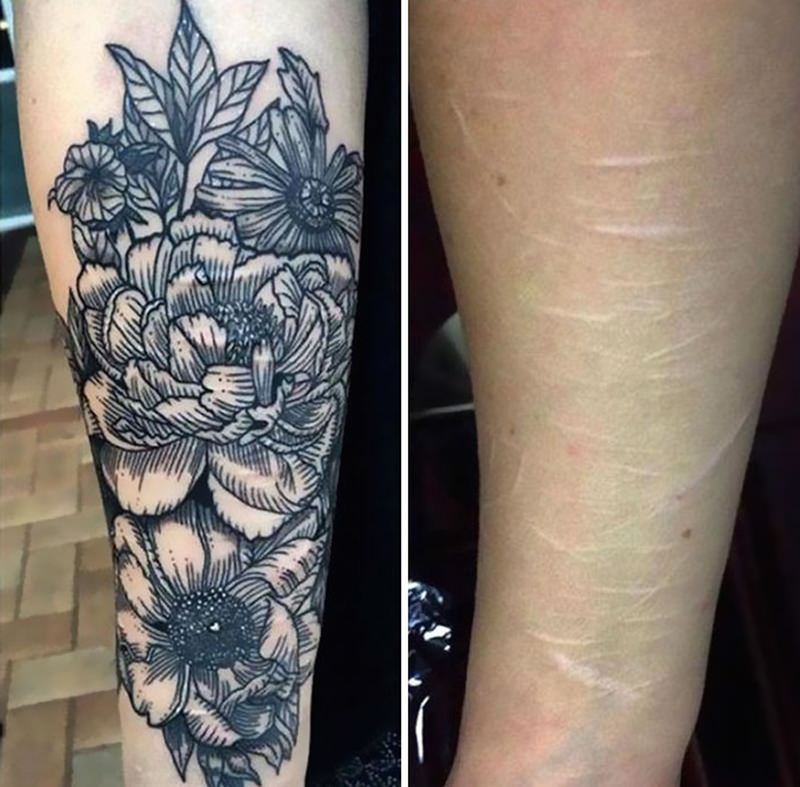 30 ideia criativas de tatuagem para embelezar qualquer cicatriz 11